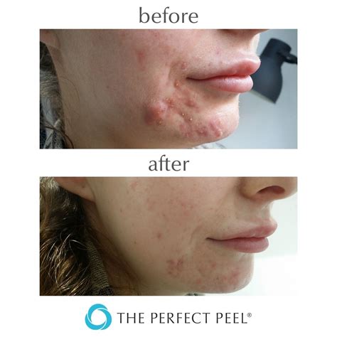 The Perfect Peel® Inside Aesthetics