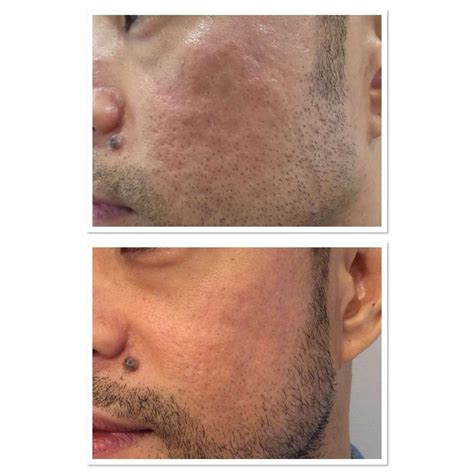 Acne Scar Before & After Treatment | Parfaire Medical Aesthetics Pasadena