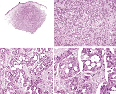 Two of our cases belonged to the cribriform variant of CAC, with a ...