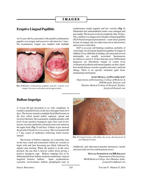 (PDF) Eruptive Lingual Papillitis