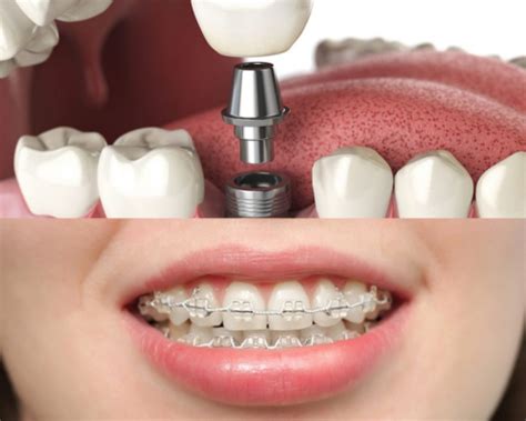 Góc giải đáp Trồng răng implant có niềng răng được không