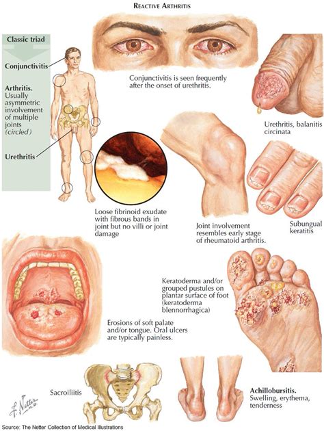 Manual Of Medicine On Twitter Symptoms And Signs Of Reactive