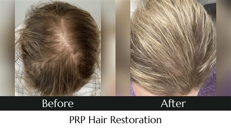 Prp Hair Restoration