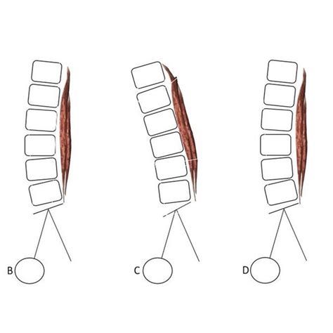 A Normalnormal Lumbar Lordosis With Normal Paravertebral Musclesbc