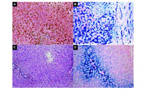 The Liver Histopathology Of The Proband [panel A B Ii 1] And The