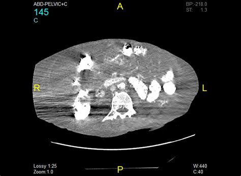 Radiopaedia Case Pseudomembranous Colitis Id Study Nc