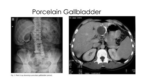 Gallbladder Disease Ppt