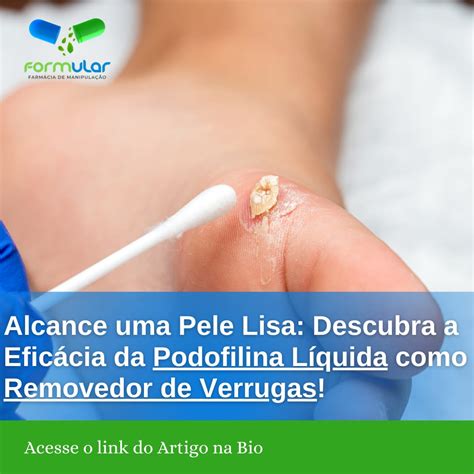 Podofilina Tratamento Eficaz De Verrugas Ml L Quido