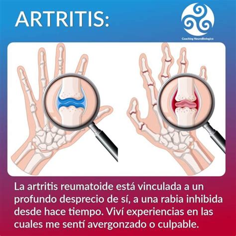 Biodescodificación De La Artritis Sanar Las Heridas Coaching De