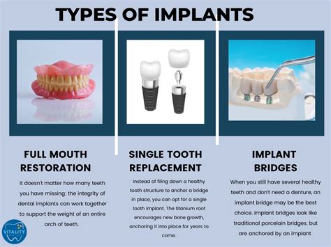 Ppt The Top Benefits Of Dental Implants You Didn T Know About