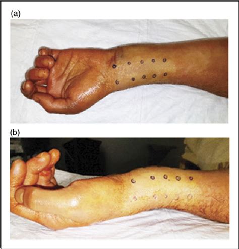 Figure 1 From Distal Radius Fracture Volar Locking Plate Osteosynthesis Using Wide Awake Local