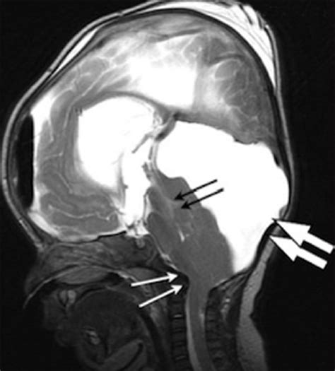 Mri Scan Taken After Etv And Evd Insertion Showing Wide Supratentorial Download Scientific