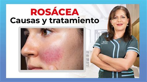 Ros Cea Afecci N Del Rostro Y Sus Tipos C Mo Diferenciarla Del Acn