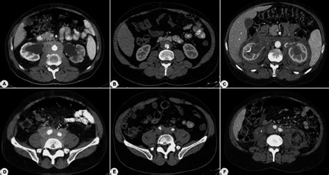 Representative Abdominal Contrast Enhanced Computed Tomographic Ct