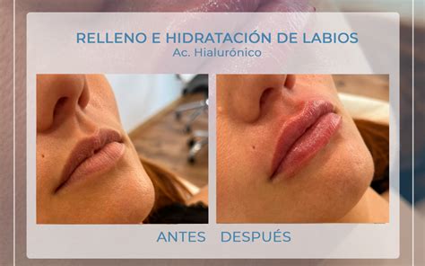 Aumento de labios finos transformación increíble antes y después