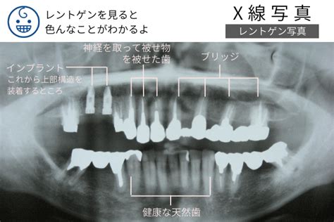 歯科のレントゲンについて教えて｜クローバー歯科豊中駅前アネックス