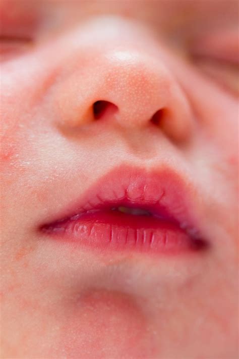 Red Spots On Baby S Lips