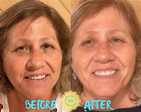 Infrared Thermal Facelift Anti Aging Treatment The Villages Fl