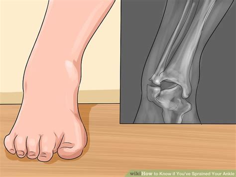 Expert Advice On How To Know If Youve Sprained Your Ankle