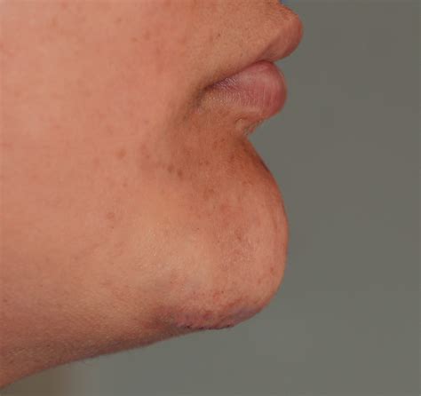 Plastic Surgery Case Study Chin Reduction With Submental Resection Of