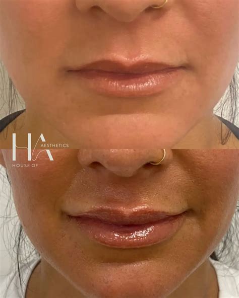 Lip Fillers Near You In Huntington Beach Natural Looking Lips