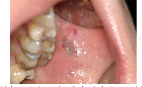 Figure 1 From Oral Malignant Melanoma Semantic Scholar