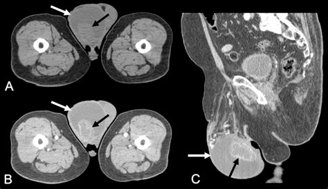 Pelvic Computed Tomography In The Axial A And B And Sagittal C