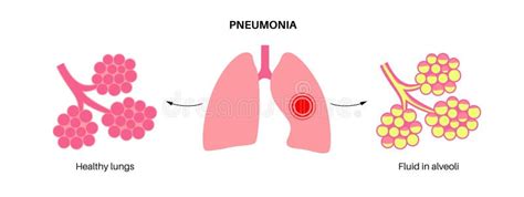 P Ster De Infecci N Por Neumon A Ilustraci N Del Vector Ilustraci N