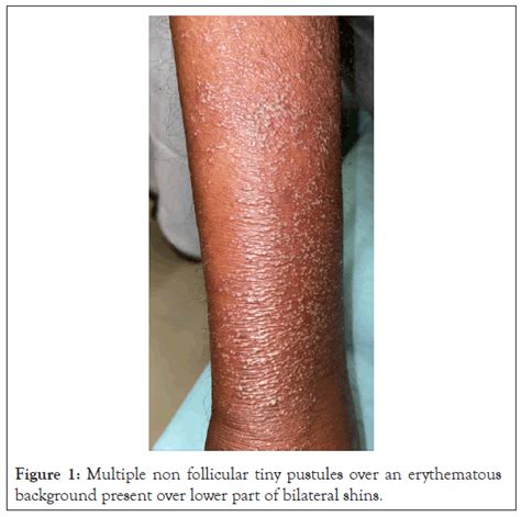 Hansens Reaction Presenting As Acute Generalized Exanthematous