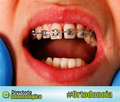 Ortodoncia Colocaci N De Brackets Paso A Paso Directorio Odontol Gico