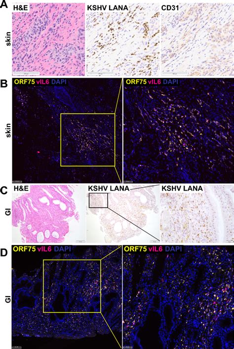 Expression Of Kshv And Human Genes In Ks Lesions A Sections From Ks