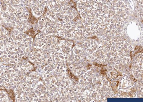 Nests Of Tumor Cells Intersected By Fibrous Septa A The Septa Were