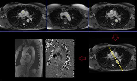 Cardiac Mri Flow Quantification Protocols Planning And Techniques