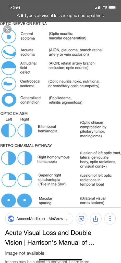 Visual Field Test For Pituitary Tumor - mapametawan