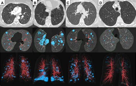 Diffuse Cystic Lung Disease Chest