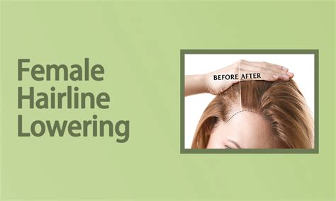 Female Hairline Lowering