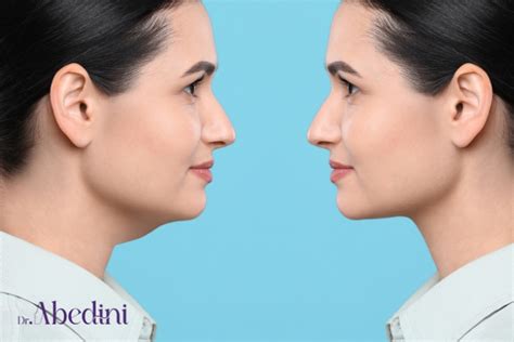 What To Expect After Double Chin Surgery Dr Abedini