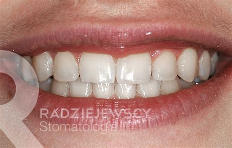 Metamorfozy Stomatologia Radziejewscy Ortodoncja I Nak Adki Invisalign