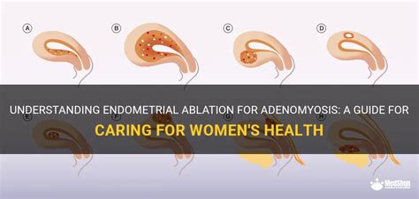 Understanding Endometrial Ablation For Adenomyosis A Guide For Caring