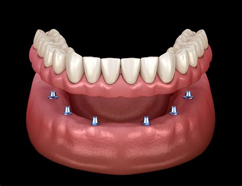 Denture Implants Nova Denture Center Coquitlam Lower Mainland