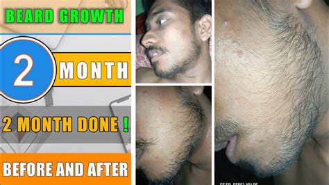 Beard Growth Get More Density In Your Beard Month Done Before And