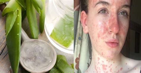 Traitement Naturel Du Psoriasis L Aloe Vera Le Soigner En Jours