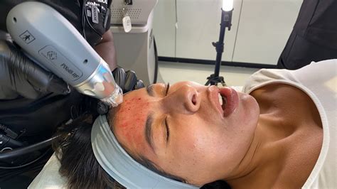 Rohrer Aesthetics Pixel8 Multiple Level Microneedling Rf Acne Scars In