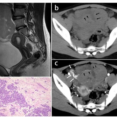 A 24 Year Old Woman With Dysgerminoma In The Left Ovary A Coronal