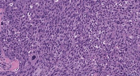 Hpv Associated Squamous Cell Carcinoma Of The Oropharynx Ottawa Atlas