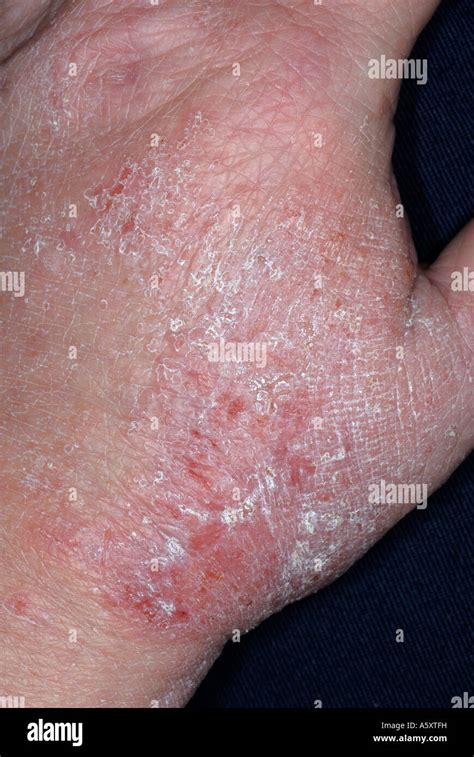 Eczema Rash On Hands