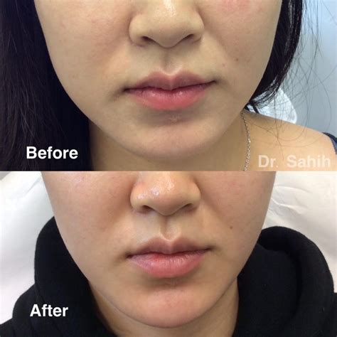 Masseter Botox Richmond Laser And Cosmetic