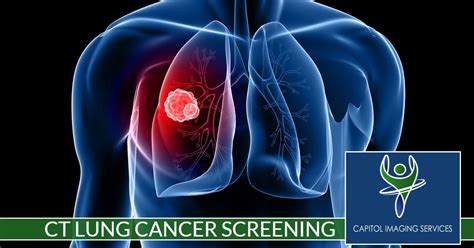 CT Lung Cancer Screening - Capitol Imaging Services