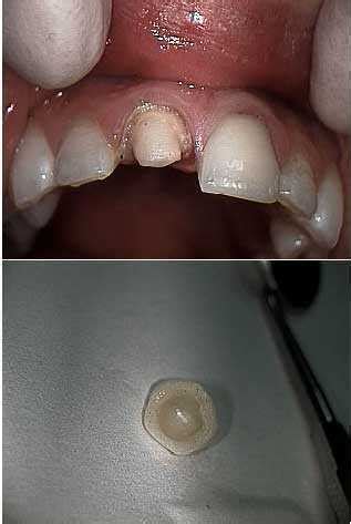 Dental Cements Luting Agents And Glue For Crowns