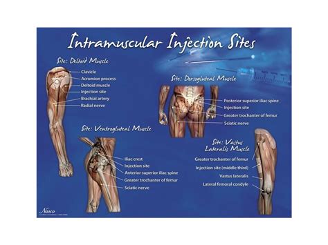 Intramuscular Injection sites - poster - Simulaids